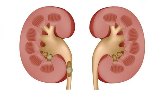 輸尿管堵塞腎積水怎么辦