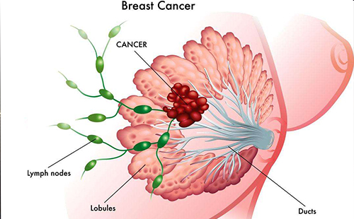 乳腺癌的早期癥狀有哪些 如何預(yù)防