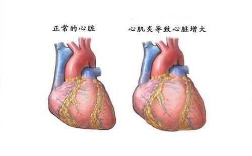 感冒后不要運(yùn)動容易導(dǎo)致心肌炎