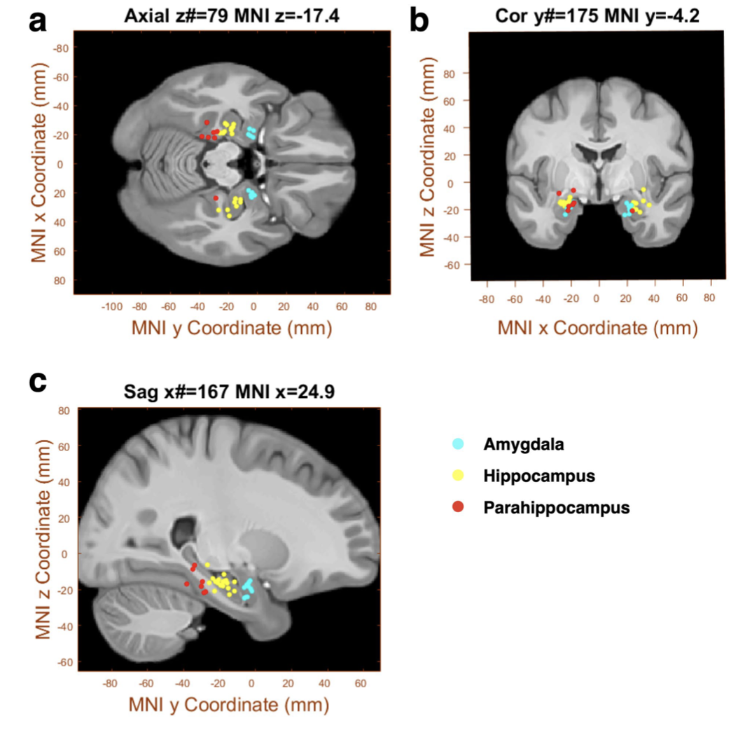 杏仁核（藍色）、海馬（黃色）或海馬旁回（紅色）